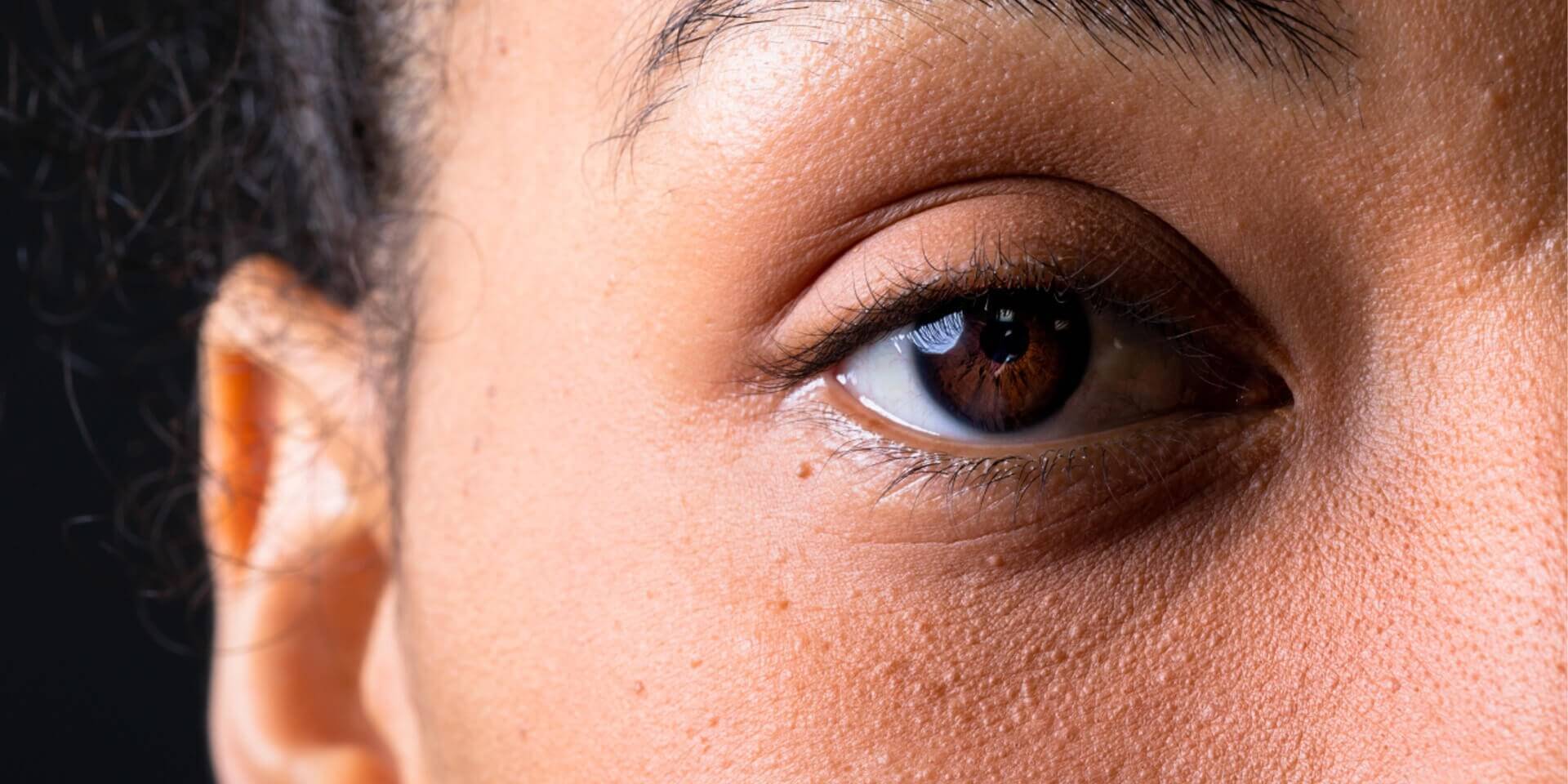 What are Dark Circles and What Causes them
