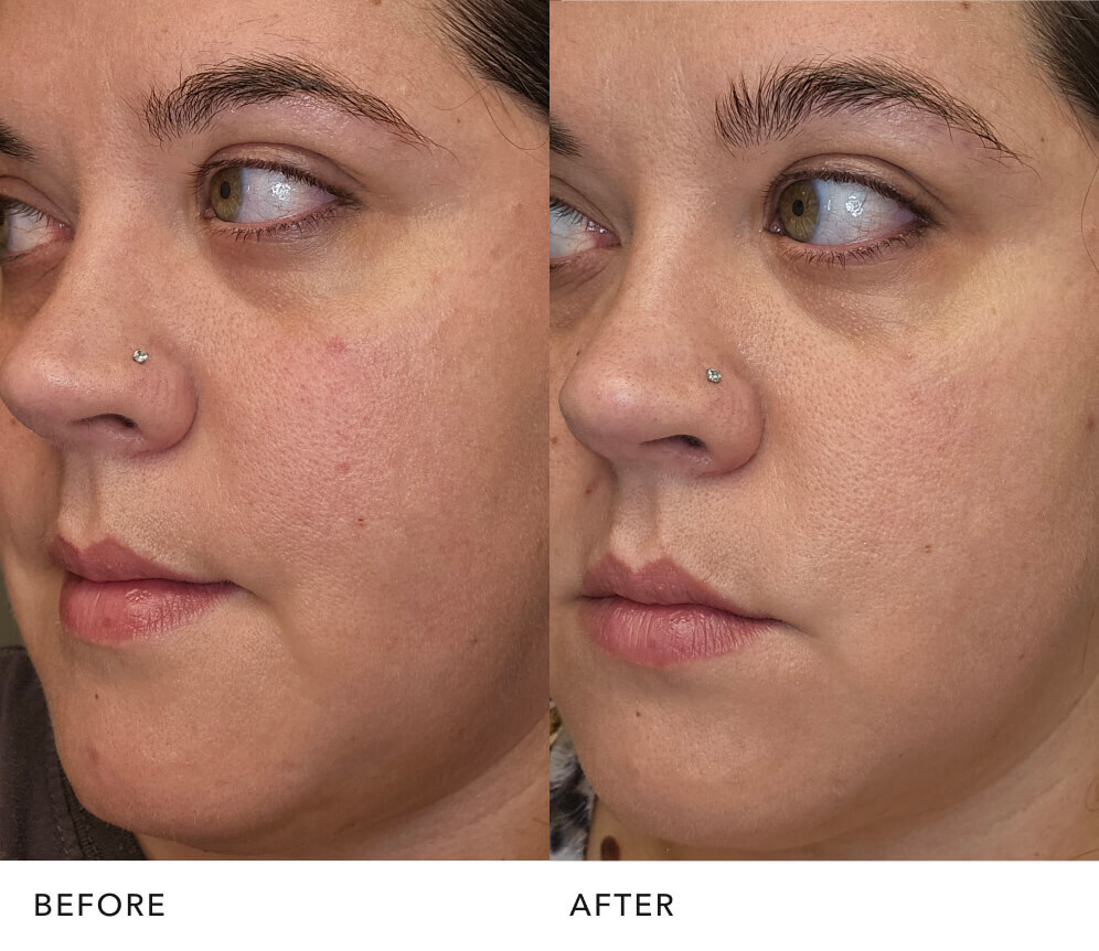  Before and after skin improvement with PITERA™ essence: Improved Skin Texture | SK-II USA