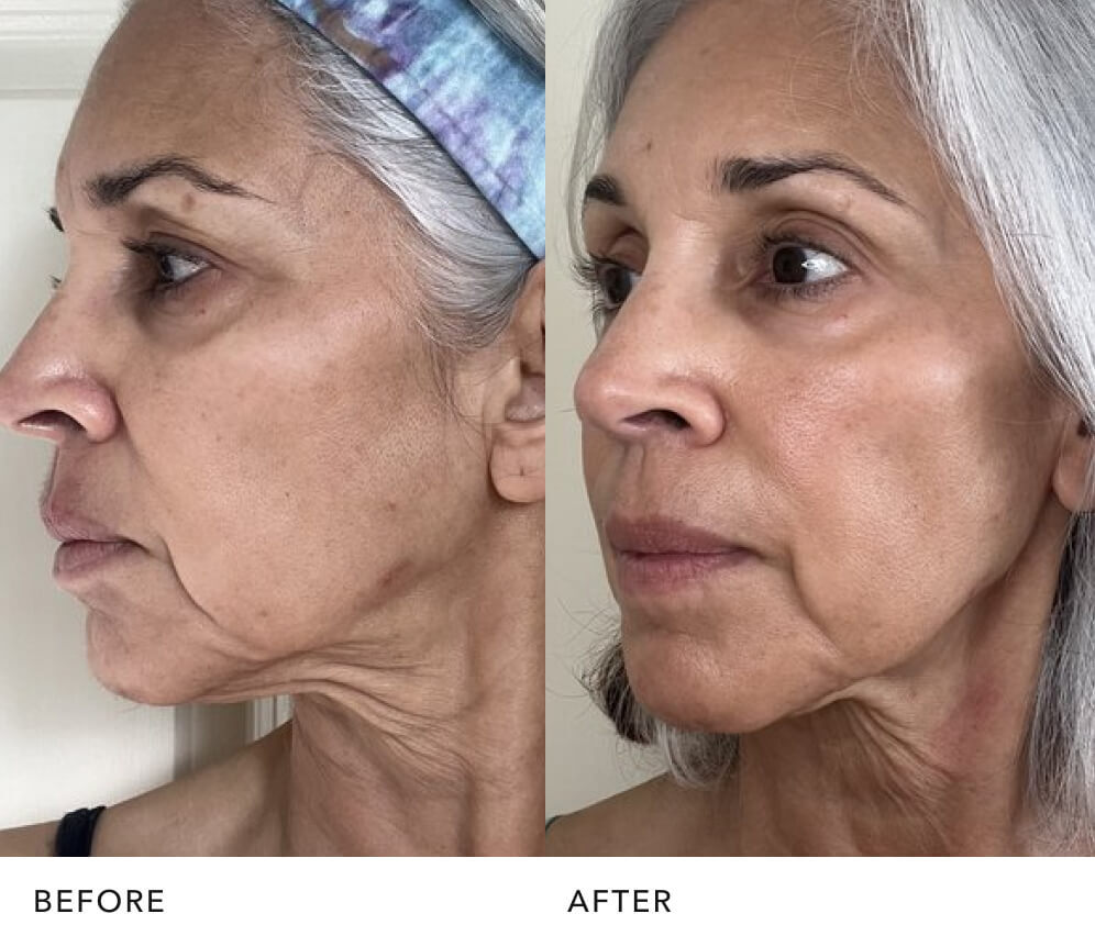  Before and after skin improvement with PITERA™ essence: Brighter, Firmer, Smoother skin by SK-II USA