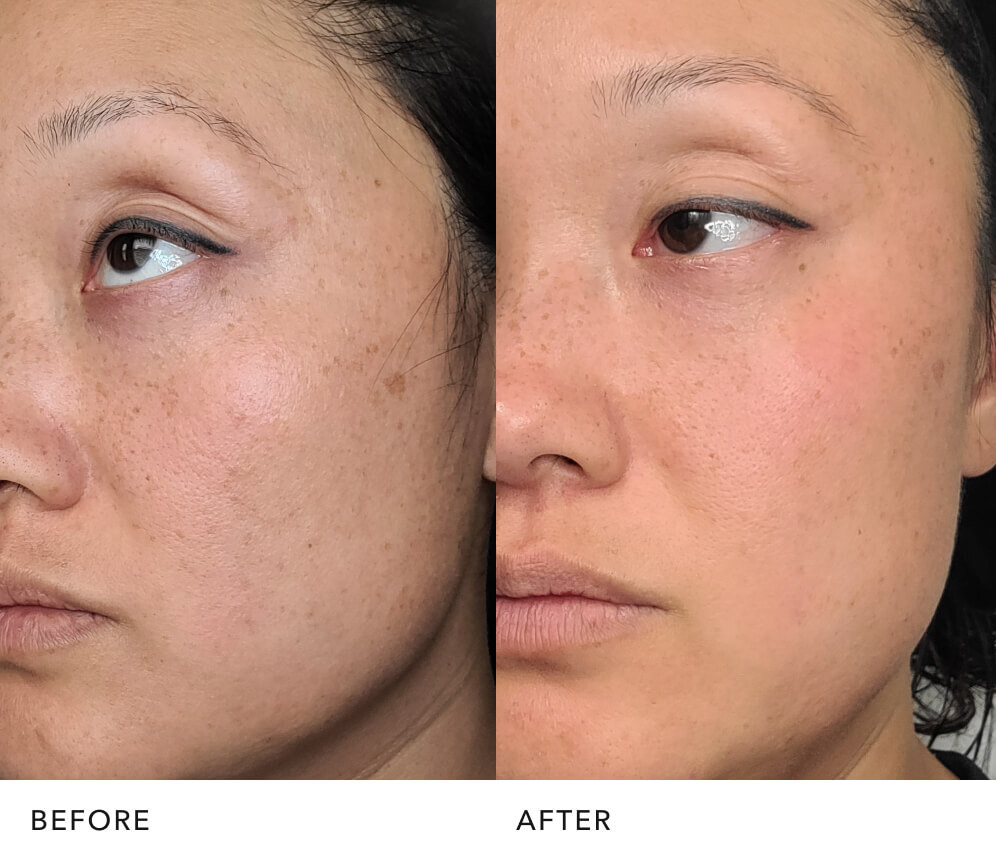  Before and after skin improvement with PITERA™ essence: Radiant Looking Skin | SK-II USA